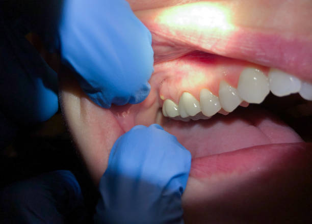 Best Emergency Dental Extractions in Seaford, DE